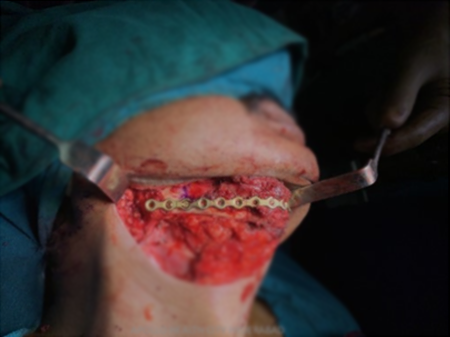 Jaw Bone Cancer Treatment in India
